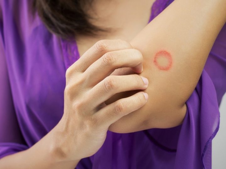 Infeksi Kulit Karena Jamur Ini Cara Mengobati Ringworm Pada Manusia